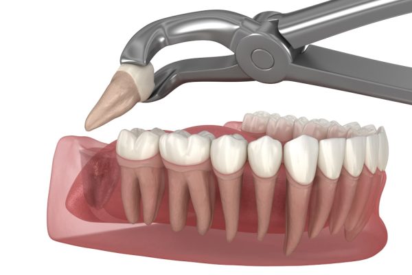 wisdom tooth extractions